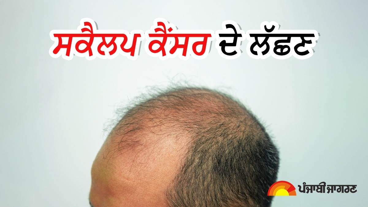 Skin Cancer : ਕੈਂਸਰ ਦਾ ਸੰਕੇਤ ਹੋ ਸਕਦੇ ਹਨ ਸਕੈਲਪ 'ਤੇ ਨਜ਼ਰ ਆ ਰਹੇ ਇਹ ਲੱਛਣ, ਭਾਰੀ ਪੈ ਸਕਦੀ ਹੈ ਅਣਦੇਖੀ