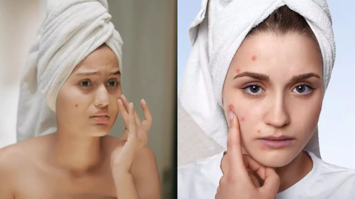 Blackheads vs Whiteheads: ਦੇਖਣ ਨੂੰ ਇੱਕੋ ਜਿਹੇ ਲੱਗਦੇ ਹਨ ਪਰ ਹਨ ਵੱਖਰੇ; ਇਨ੍ਹਾਂ ਤੋਂ ਕਿਵੇਂ ਛੁਟਕਾਰਾ ਪਾਇਆ ਜਾਵੇ?