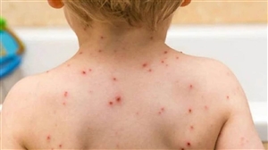 Monkeypox Symptoms: Monkeypox ਦੇ ਬ੍ਰਿਟਿਸ਼ ਮਰੀਜ਼ਾਂ 'ਚ  ਮਿਲੇ ਵੱਖੋ-ਵੱਖਰੇ ਲੱਛਣ, ਜਿਨਸੀ ਸਬੰਧਾਂ ਨਾਲ ਵੀ ਫੈਲ ਸਕਦੀ ਹੈ ਇਹ  ਬਿਮਾਰੀ