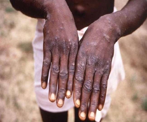 Monkeypox Virus : ਕੋਰੋਨਾ ਤੋਂ ਬਾਅਦ ਹੁਣ ਬ੍ਰਿਟੇਨ 'ਚ ਮਿਲਿਆ Monkeypox ਵਾਇਰਸ ਦਾ ਮਾਮਲਾ, ਜਾਣੋ ਕੀ ਹਨ ਲੱਛਣ