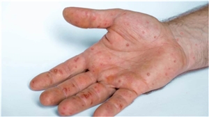 Monkeypox Symptoms: ਨਵੀਂ ਖੋਜ 'ਚ ਸਾਹਮਣੇ ਆਏ ਮੰਕੀਪੌਕਸ ਦੇ ਦੋ ਨਵੇਂ ਲੱਛਣ, ਇਨ੍ਹਾਂ ਬਾਰੇ ਜਾਣੋ ਜ਼ਰੂਰ