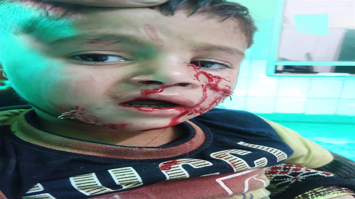 ਚਾਰ ਸਾਲਾ ਮਾਸੂਮ 'ਤੇ ਆਵਾਰਾ ਕੁੱਤਿਆਂ ਦਾ ਕਹਿਰ,ਨੋਚ-ਨੋਚ ਕੀਤਾ ਬੁਰਾ ਹਾਲ; ਚਿਹਰੇ ’ਤੇ ਲੱਗੇ 55 ਟਾਂਕੇ