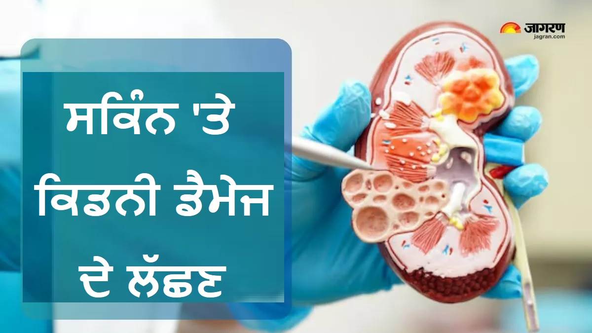 Kidney Damage ਹੋਣ 'ਤੇ ਸਕਿੰਨ 'ਤੇ ਨਜ਼ਰ ਆਉਂਦੇ ਹਨ 8 ਲੱਛਣ, ਮਾਮੂਲੀ ਸਮਝ ਕੇ ਬਿਲਕੁਲ ਨਾ ਕਰਿਓ ਇਗਨੋਰ