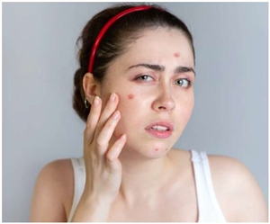 Pimple Home Remedies :  ਜੇ ਤੁਸੀਂ ਵੀ ਹੋ ਪਿੰਪਲ ਤੋਂ ਪਰੇਸ਼ਾਨ ਤਾਂ ਅਪਣਾਓ ਇਹ ਘਰੇਲੂ ਫੇਸ ਪੈਕ, ਜਲਦ ਮਿਲੇਗੀ ਤੁਹਾਨੂੰ ਰਾਹਤ