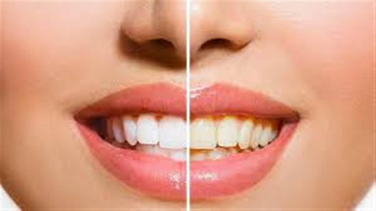 Teeth Whitening Tips : ਦੰਦਾਂ ਦੇ ਪੀਲੇਪਣ ਤੋਂ ਤੁਸੀ ਵੀ ਹੋ ਪਰੇਸ਼ਾਨ ਤਾਂ ਅਪਣਾਓ ਇਹ ਘਰੇਲੂ ਨੁਸਖੇ, ਮਿਲੇਗੀ ਮੋਤੀਆਂ ਵਰਗੀ ਚਮਕ
