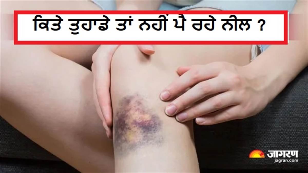 ਬਿਨਾਂ ਸੱਟ ਲੱਗੇ ਸਰੀਰ ਹੋ ਰਿਹਾ ਹੈ ਨੀਲਾ? ਡਾਕਟਰਾਂ ਨੇ ਦਿੱਤੀ ਚਿਤਾਵਨੀ, ਨਜ਼ਰਅੰਦਾਜ਼ ਕਰਨਾ ਪੈ ਸਕਦਾ ਹੈ ਭਾਰੀ