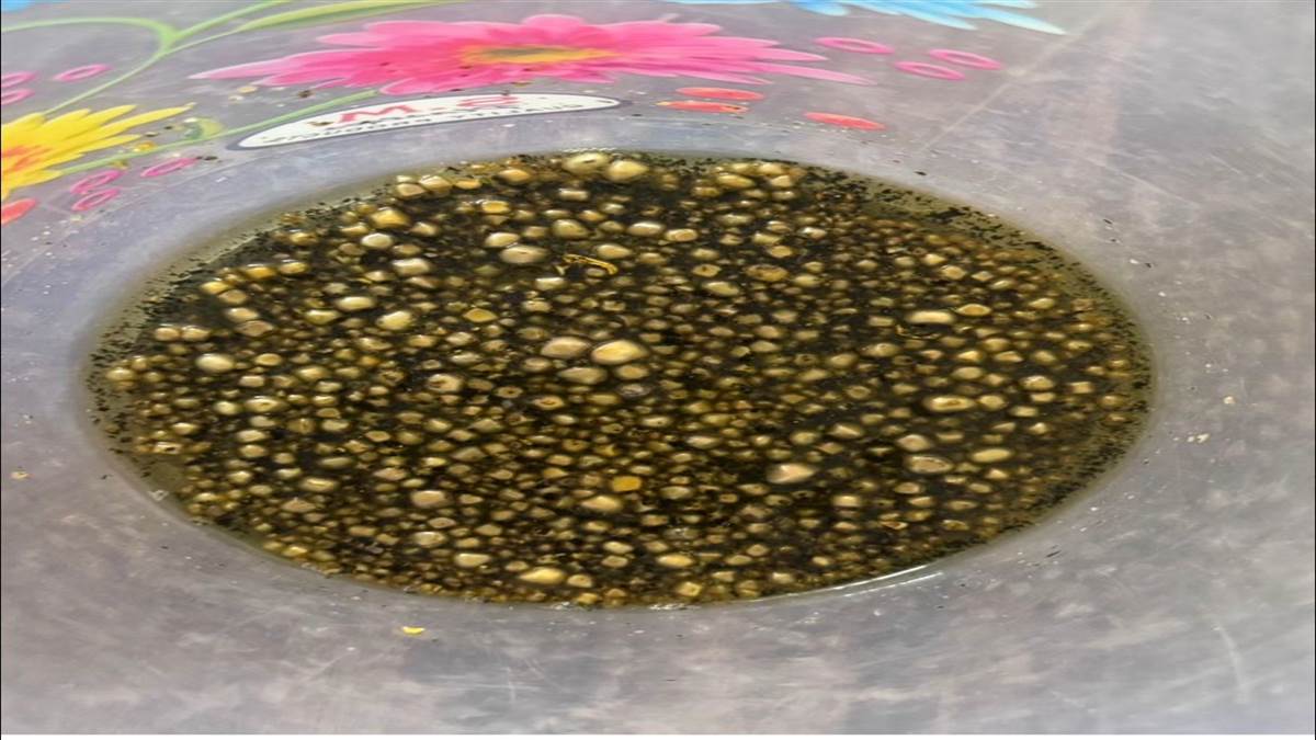 ਦੂਰਬੀਨ ਨਾਲ ਪਿੱਤੇ ’ਚੋਂ ਕੱਢੀਆਂ 450 ਪਥਰੀਆਂ
