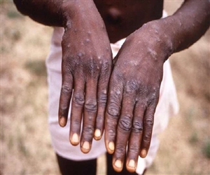 Monkeypox Virus:ਕੋਰੋਨਾ ਤੋਂ ਬਾਅਦ ਹੁਣ Monkeypox ਦਾ ਵਧਿਆ ਖਤਰਾ, ਅਮਰੀਕਾ 'ਚ ਵੀ ਦਸਤਕ, ਜਾਣੋ ਕੀ ਹਨ ਲੱਛਣ