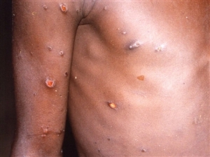 Monkeypox Outbreak 2022 : ਕੀ ਕੋਰੋਨਾ ਵਾਂਗ ਇੱਕ ਘਾਤਕ ਮਹਾਮਾਰੀ ਬਣ ਜਾਵੇਗਾ Monkeypox, ਪੜ੍ਹੋ ਮਾਹਰਾਂ ਦੀ ਰਾਏ