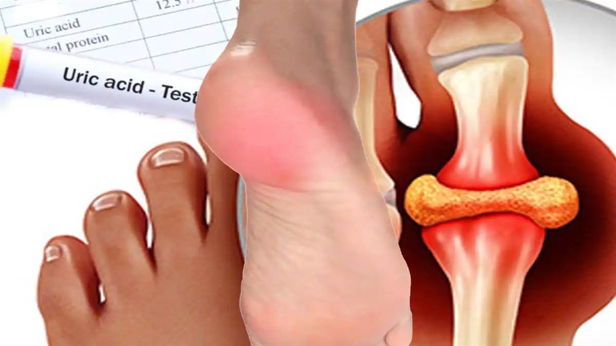 Uric Acid Remedy : ਬਗ਼ੈਰ ਬ੍ਰਸ਼ ਕੀਤੇ ਸਵੇਰੇ ਪੀਓ ਇਹ ਕਾੜ੍ਹਾ, ਤੁਰੰਤ ਘੱਟ ਜਾਵੇਗਾ ਯੂਰਿਕ ਐਸਿਡ