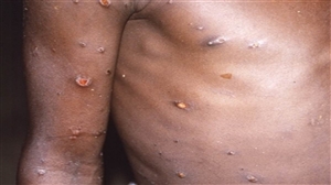monkeypox global emergency:  WHO ਨੇ ਮੰਕੀਪਾਕਸ ਨੂੰ ਗਲੋਬਲ ਐਮਰਜੈਂਸੀ ਐਲਾਨਿਆ,  70 ਦੇਸ਼ਾਂ ਵਿਚ ਫੈਲ ਚੁੱਕਾ ਹੈ ਇਹ ਵਾਇਰਸ