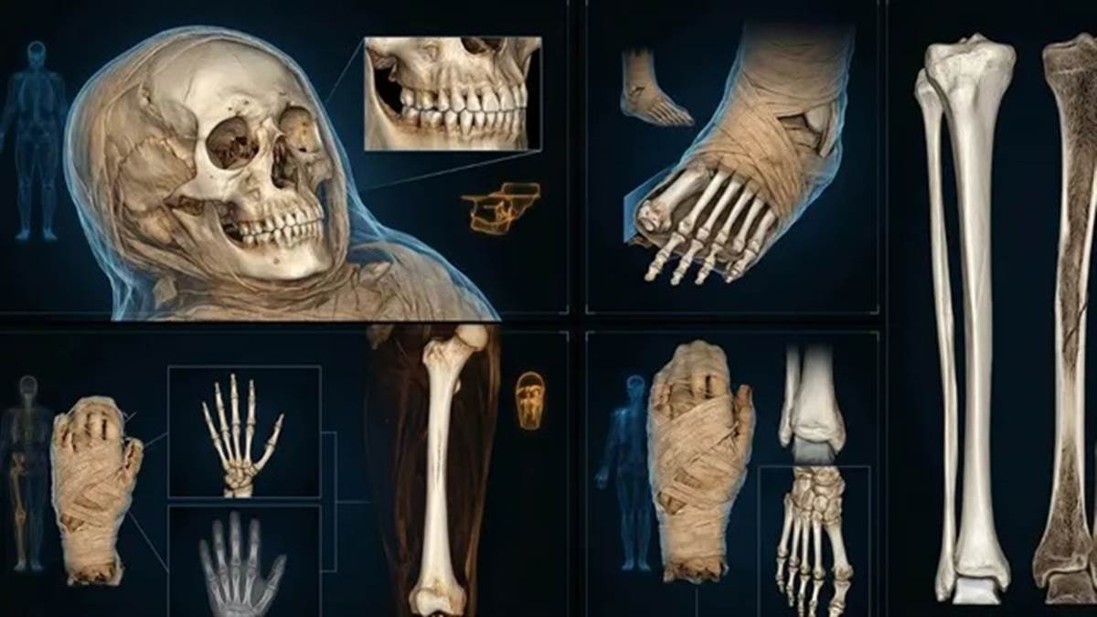 ਖੋਪੜੀ, ਗਾਇਬ ਅੰਗੂਠਾ ਤੇ ਬਿਮਾਰੀਆਂ... 2300 ਸਾਲ ਪੁਰਾਣੀ ਮਿਸਰ ਦੀ ਮੰਮੀ ਦੇ ਅੰਦਰ CT ਸਕੈਨ ਨਾਲ ਹੋਰ ਕੀ-ਕੀ ਦਿਖਿਆ?