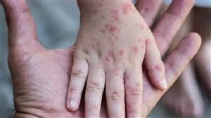 Monkeypox Update in India : WHO ਨੇ ਕਿਹਾ - Corona ਤੇ Monkeypox ਵੱਡੀ ਚੁਣੌਤੀ, ਭਾਰਤ ਸਰਕਾਰ ਵੀ ਐਕਸ਼ਨ ਮੋਡ 'ਚ