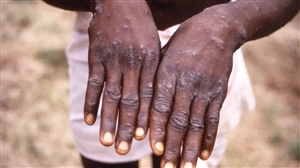 Monkeypox in India:   ਦੁਨੀਆ ਭਰ 'ਚ ਤੇਜ਼ੀ ਨਾਲ ਫੈਲ ਸਕਦੈ Monkeypox, ਕੇਸਾਂ ਦੀ ਗਿਣਤੀ 5 ਗੁਣਾ ਵਧੀ; ਭਾਰਤ 'ਚ ਵੀ ਖ਼ਤਰਾ ਵਧਿਆ