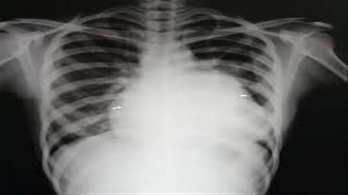 ਅੰਮ੍ਰਿਤਸਰ ’ਚ ਮਿਲਿਆ ਲਿਊਟੇਂਬੇਚਰ ਸਿੰਡ੍ਰੋਮ ਪੀੜਤ ਵਿਸ਼ਵ ਦਾ 24ਵਾਂ ਮਰੀਜ਼, ਸਿਰਫ਼ ਔਰਤਾਂ ਨੂੰ ਹੁੰਦੀ ਹੈ ਇਹ ਬਿਮਾਰੀ