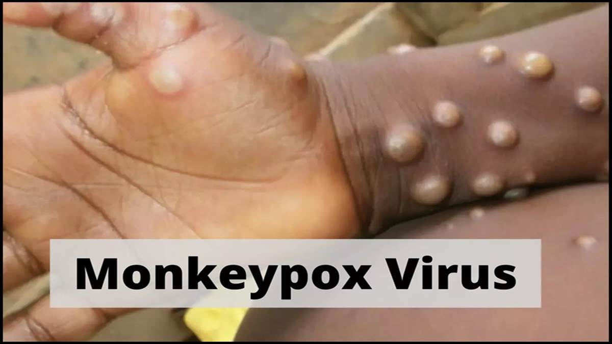 Monkeypox Monkeypox reaches 15 countries Ministry of Health issues this advisory to the states