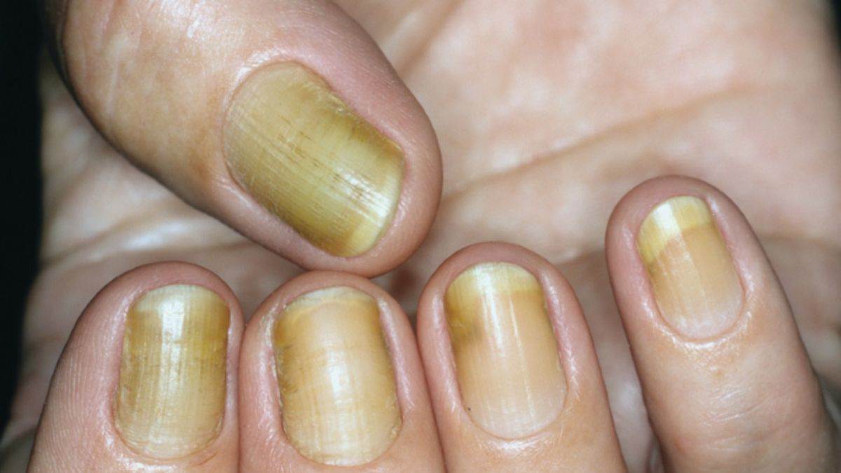 Yellow Nail Syndrome : ਕੀ ਤੁਹਾਡੇ ਵੀ ਨਹੁੰ ਪੀਲੇ ਹਨ ਤਾਂ ਹੋ ਜਾਓ ਸਾਵਧਾਨ ...