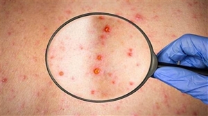 Monkeypox in US : 5 'ਚੋਂ 1 ਅਮਰੀਕੀ ਨੂੰ ਮੰਕੀਪੌਕਸ ਹੋਣ ਦੀ ਸੰਭਾਵਨਾ, ਪਰ ਬਹੁਤ ਘੱਟ ਲੋਕ ਇਸ ਬਿਮਾਰੀ ਬਾਰੇ ਜਾਗਰੂਕ